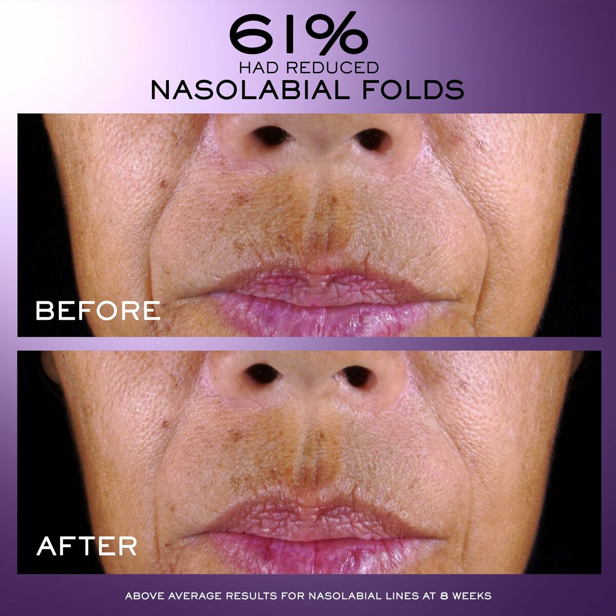 Before and after results showing reduced nasolabial folds; 61% improvement after 8 weeks.